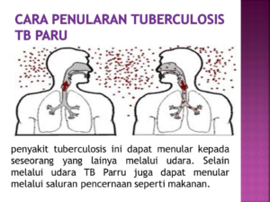 Memahami Faktor Pemicu Tuberkulosis (TBC): Kunci untuk Pencegahan dan Pengobatan