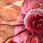 Memahami Penyebab dan Penanggulangan Tumor Ganas