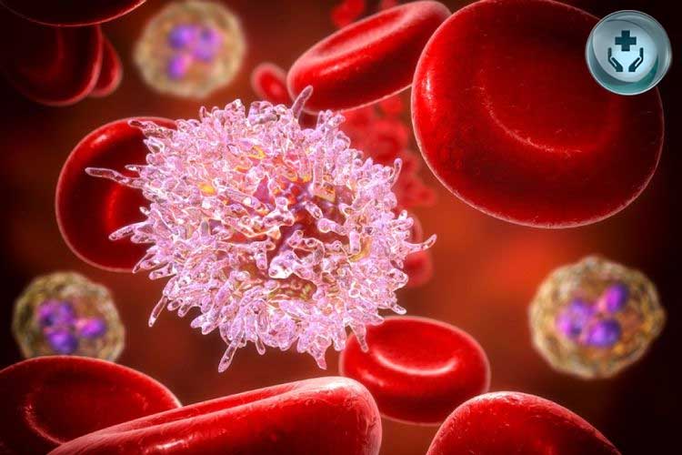 Memahami Leukemia (Kanker Darah): Penyebab, Gejala, dan Cara Pengobatannya