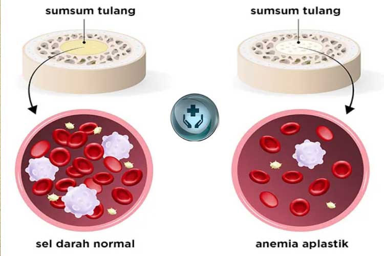 Penyakit Anemia Aplastik: Penyebab, Gejala, dan Cara Penanganannya