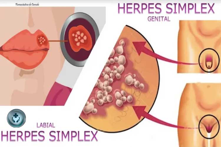 Penyakit Herpes Simplex: Penyebab, Gejala, dan Cara Mengatasi