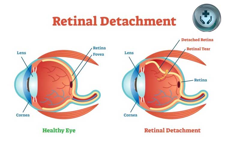 Penyakit Ablasi Retina: Penyebab, Gejala, dan Pengobatan
