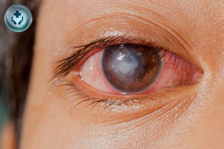 Xerophthalmia: Memahami Penyakit Mata Kering