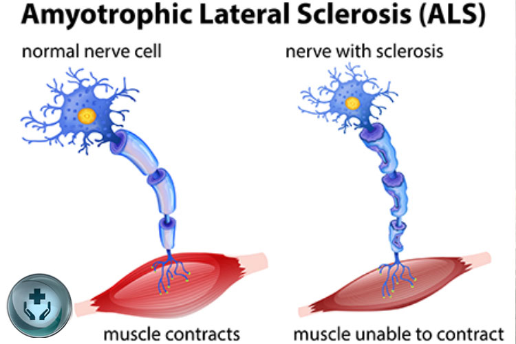 Penyakit Amyotrophic Lateral Sclerosis (ALS): Penyebab, Gejala, dan Pengobatan