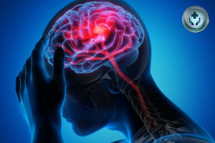 Penyakit Aneurisma Otak: Penyebab, Gejala, dan Pengobatan