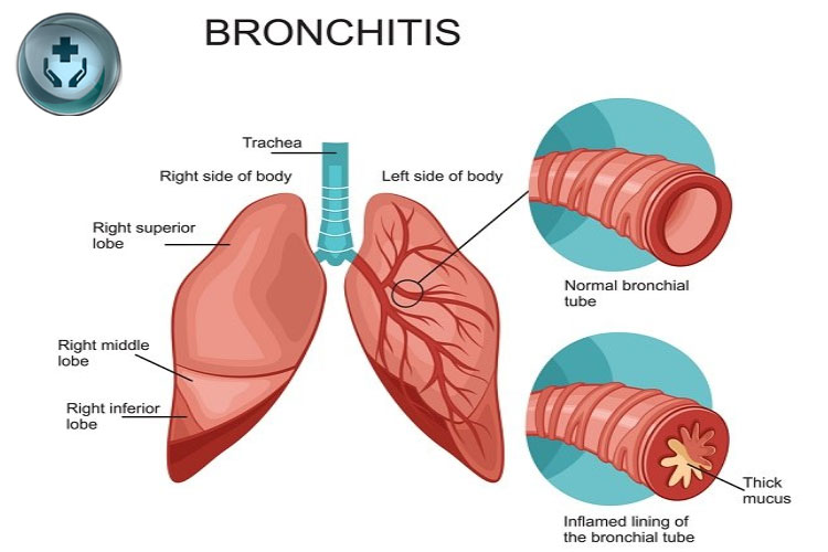 Penyakit Bronkitis: Penyebab, Gejala, dan Pengobatan