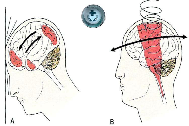 Penyakit Cedera Kepala Berat: Penyebab, Gejala, dan Pengobatan